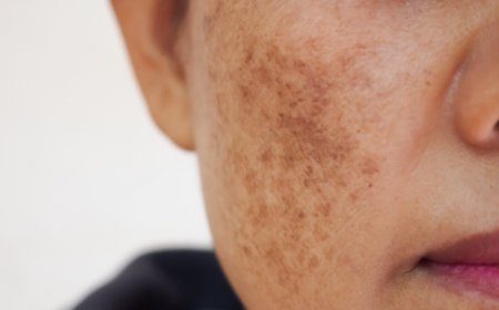 IPL Therapy for Melasma: Benefits and Risks