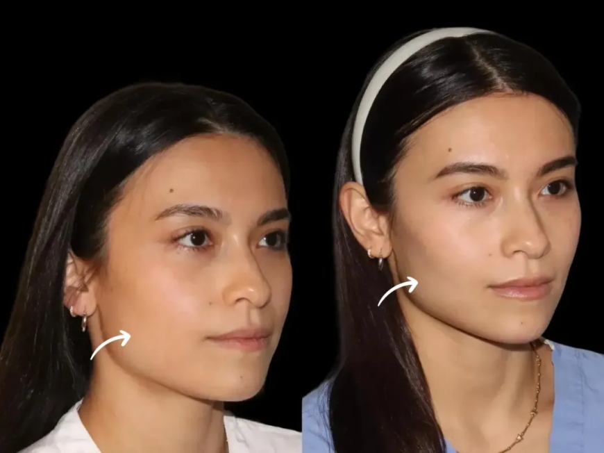 Best Doctors in Dubai Publish Groundbreaking Research on Sculptra Fillers