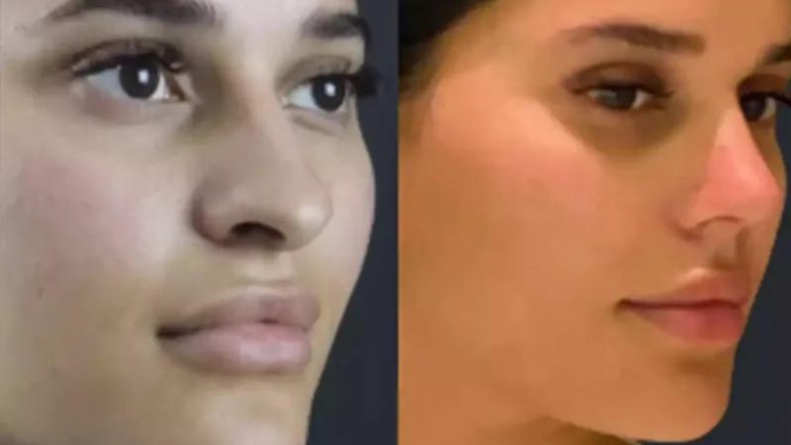Affordable Rhinoplasty in Dubai: Finding Value Without Compromise