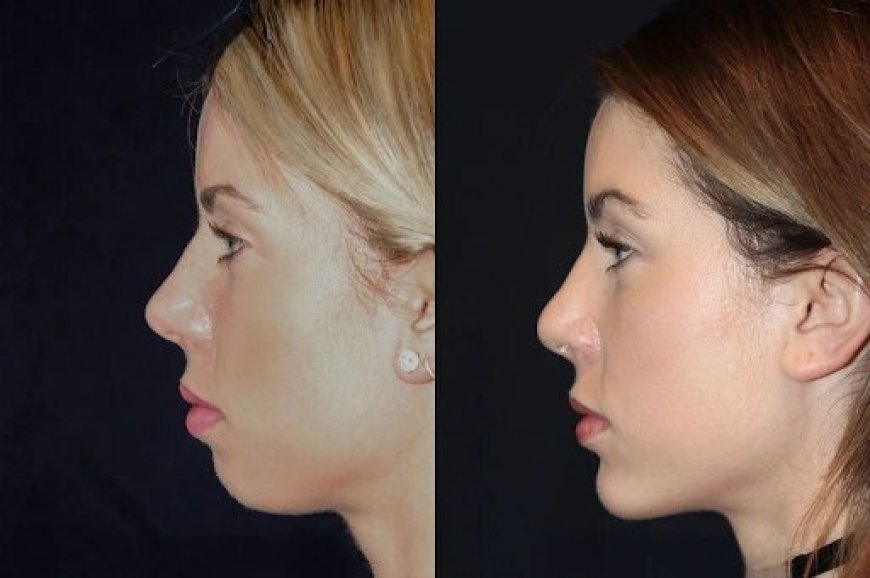 Chin Fillers Treatment in Dubai: How Long Do Results Last?