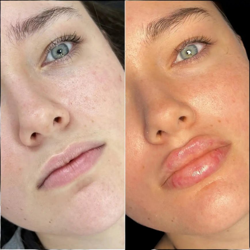 Fillers Treatment in Dubai: How to Achieve Facial Harmony