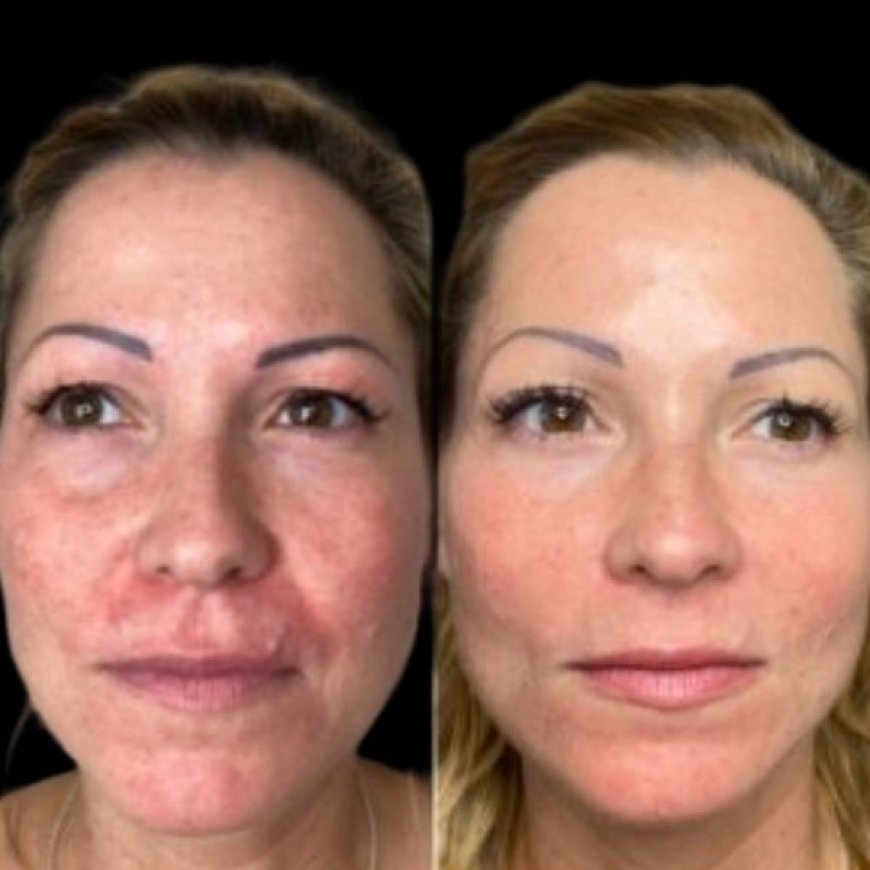 Rev Up Beauty via Profhilo by the Best Doctors in dubai