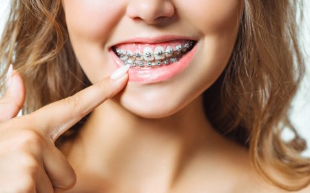 Getting Braces as an Adult: Is It Worth It?
