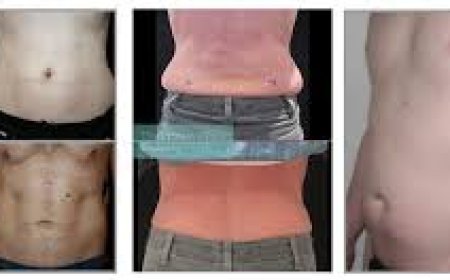 5 Questions to Ask Before Getting Liposuction Fat Removal Treatment