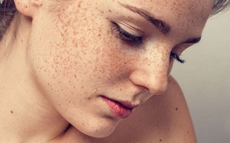 Can Melasma Go Away on Its Own? Truth vs. Myth