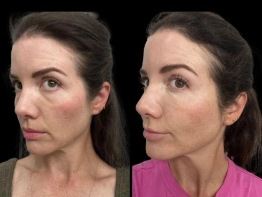 What Causes Dark Circles treatment Insights from the Best Plastic Surgeons in Dubai