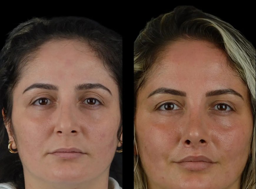 Looking for Cheek Fillers? The Best Plastic Surgeons in Dubai Have You Covered